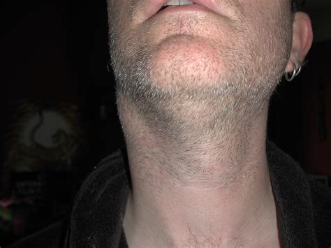 lump  lump   side   neck  swollen gland  flickr
