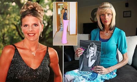 lisa brown is starving to death because of superior mesenteric artery syndrome daily mail online