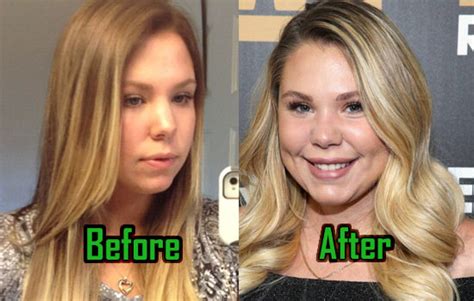 kailyn lowry plastic surgery causes addiction before after photos