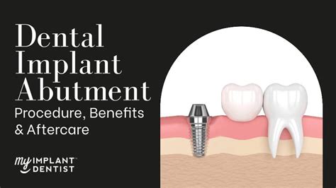 Dental Implant Abutment Procedure Benefits And Aftercare