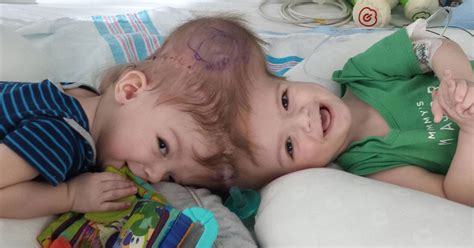 My Heart Aches Mother S Joy As Twins Conjoined At The Head Reunited