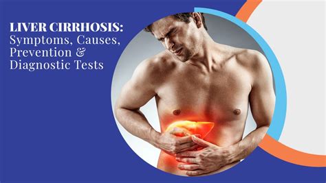 Ppt – Liver Cirrhosis Symptoms Causes Prevention And Diagnostic Tests