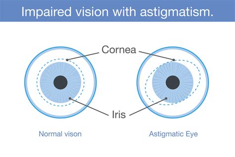 astigmatism  canadian association  optometrists