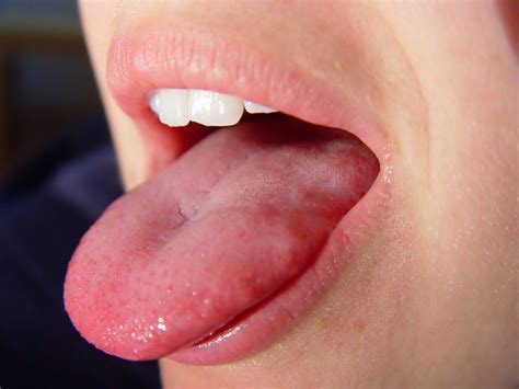 5 early symptoms of tongue cancer ebuddynews