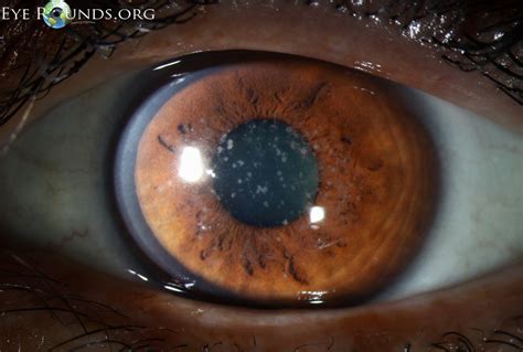 atlas entry granular corneal dystrophy type