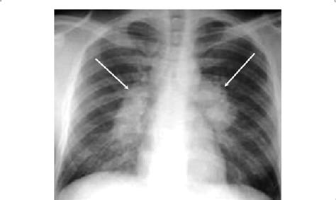 Chest X Ray Showing Bilateral Hilar Adenopathy Of Primary Pulmonary Tb