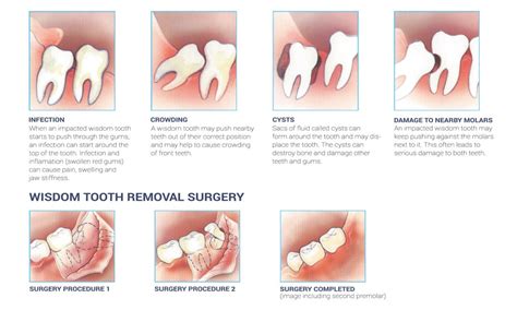 impacted wisdom teeth wisdom teeth removal wisdom teeth surgery