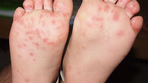hand foot and mouth disease more prevalent this year