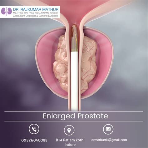 get your enlarged prostate treated by dr rajkumar mathur enlarged