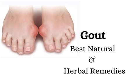 Gout Natural Ayurvedic Home Remedies How To Reduce Uric Acid At Home