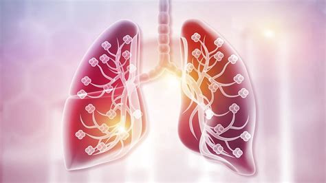 Las 10 Diferencias Entre Neumonía Y Bronquitis