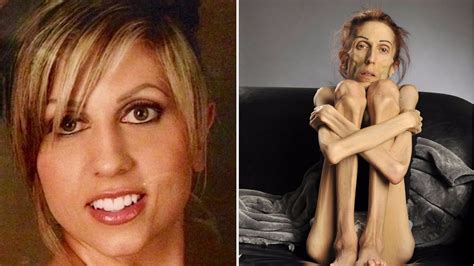 woman battling anorexia releases heartbreaking video pleading for help