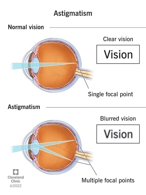 astigmatism symptoms tests treatment