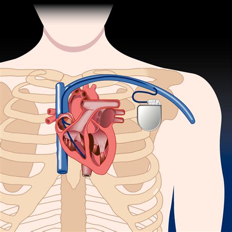heart pacemaker    frequently asked questions dr vivek baliga internal medicine