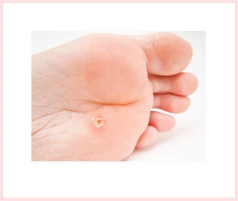 plantar wart under nail nail ftempo