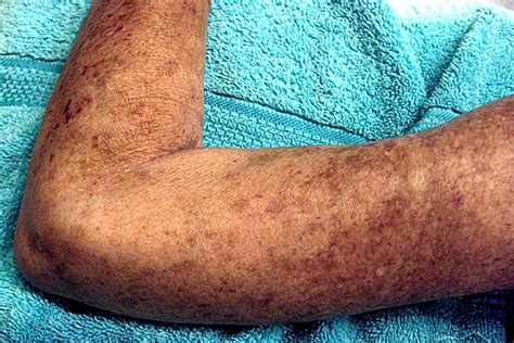 types  scleroderma systemic sclerosis