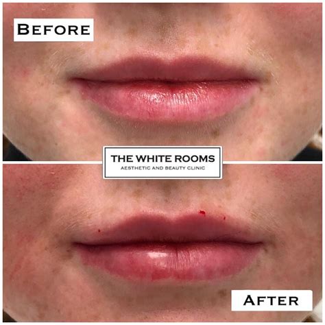 the best lip filler clinic in liverpool the white rooms clinic