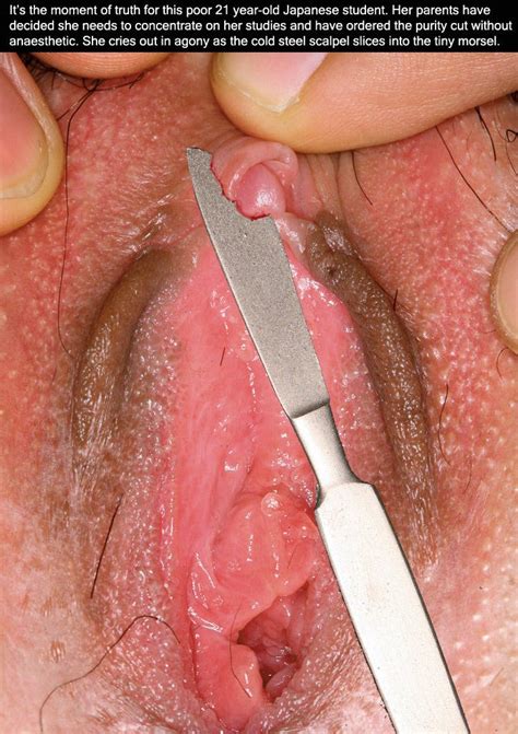 circumcised female clitoris
