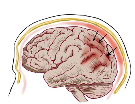 multiple sclerosis signs  multiple sclerosis relapse multiple