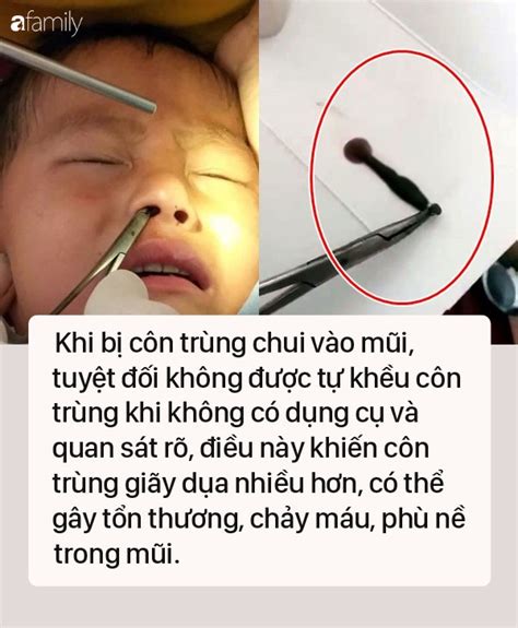 Bác Sĩ Khuyến Cáo Việc Không được Làm Khi Bị Côn Trùng Chui Vào Mũi để