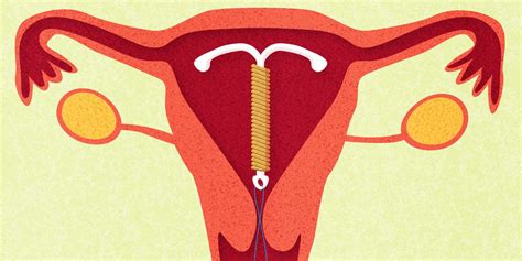 sex with an iud what you need to know