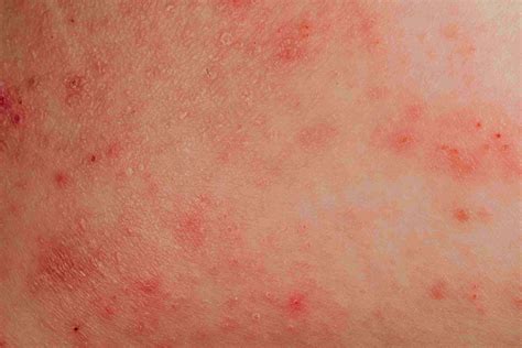 9 common rashes with blisters