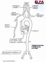 Radial Artery Angiogram Model Anatomical Sam Carotids Extended Training Plus Lfa Lakeforestanatomicals sketch template