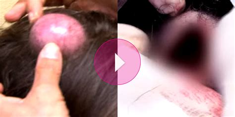 see this woman s 20 year old egg sized head cyst get