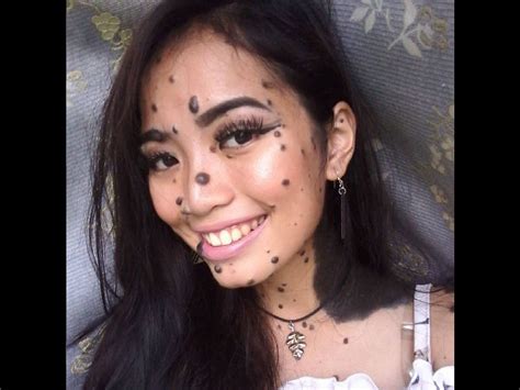 Girl Bullied As Monster Over Excessive Moles May