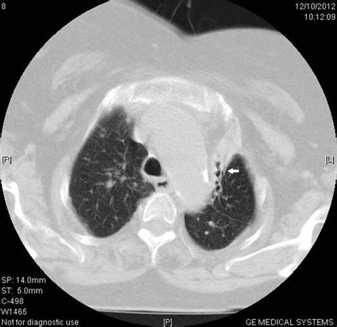 Ct Of The Thorax Showing Collapse And Consolidation Of The Upper Lobe