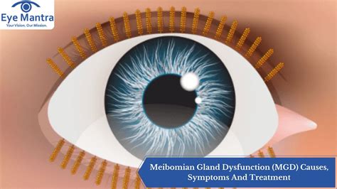 meibomian gland dysfunction mgd  symptoms  treatment
