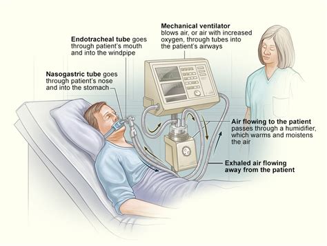 ventilatorventilator support    ventilator nhlbi nih
