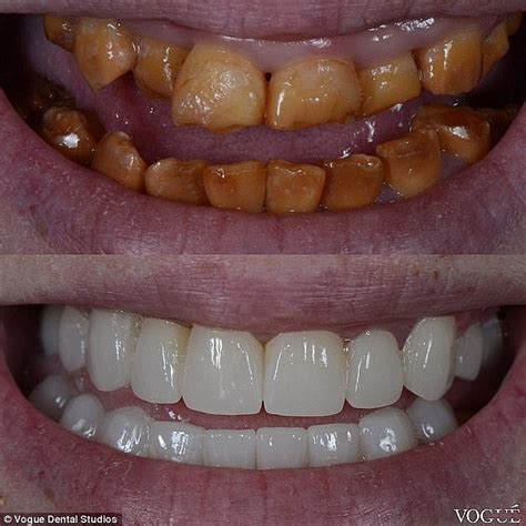 Mafs Nick Furphy Reveals 25 000 Teeth Transformation Daily Mail Online