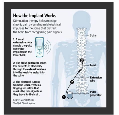 spinal cord stimulation paradigm family health