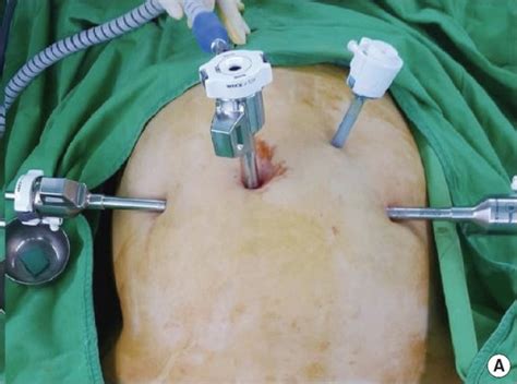 surgery hysterectomy