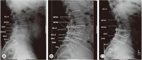 A 57 Year Old Male With Lumbar Spinal Stenosis And Spon Open I