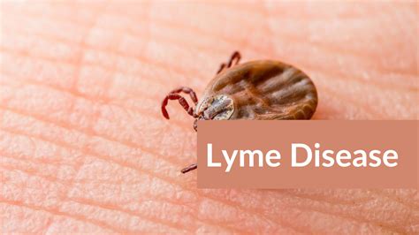 Lyme Disease Rash Symptoms In Humans And Its Different Stages