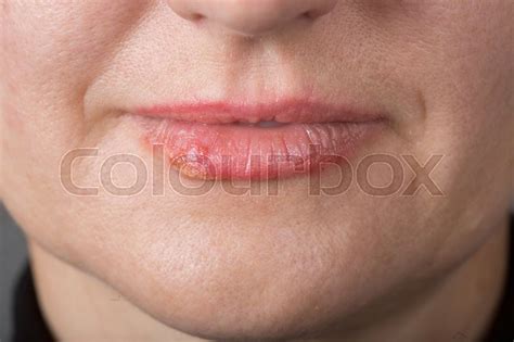 think how to get rid of facial herpes recommend