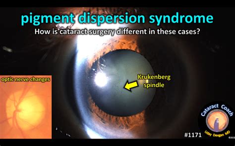 pigment dispersion syndrome cataract coach