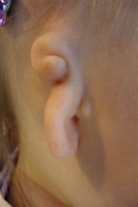 canalplasty technique ear community