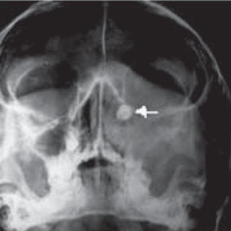 X Ray Of The Paranasal Sinuses Showing Haziness Of The Left Maxillary