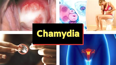 Chlamydia Pictures Causes Signs Symptoms Treatment Images And Photos
