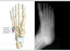 Основание плюсневой кости стопы фото Основание плюсневой кости стопы фото