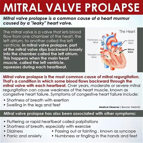 Mitral Valve Prolapse Medical Pinterest