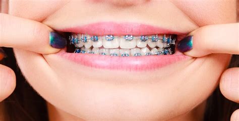 Braces For Your Teeth Why Theyre So Important In Some Cases Worthview