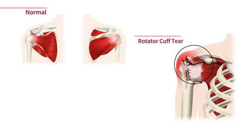 do and donts after rotator cuff surgery