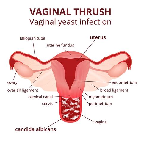 vaginal yeast infection symptoms treatment std vaginal