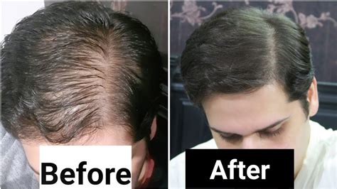 rosemary oil for hair loss my results w pictures before and after