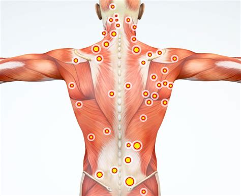 Spine Muscles In Pain Myofascial Pain Syndrome May Be To
