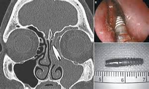 Doctors Discover A Dental Implant In Woman S Nose After She Suffered